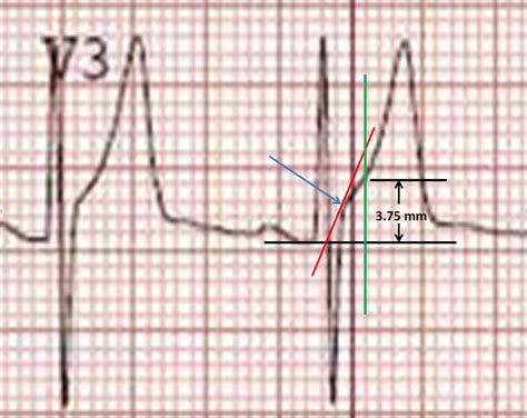 Dr. Smith's ECG Blog: How to measure ST Elevation at 60 milliseconds after the J-point in lead ...