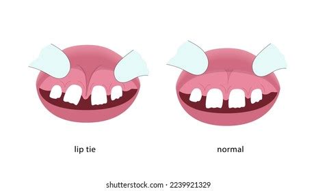 Lip Tie Illustration Before After Surgery Stock Vector (Royalty Free) 2239921329 | Shutterstock