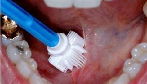 “Lab on a chip” technique may be able to detect oral cancer – Oral Cancer News