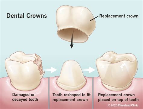 Dental Crowns: Types, Procedure & Care