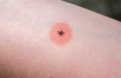 Poisonous Ticks Bites