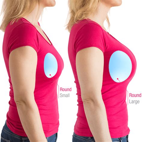 What Makes Breast Implants Look "Natural?" | Naples, FL