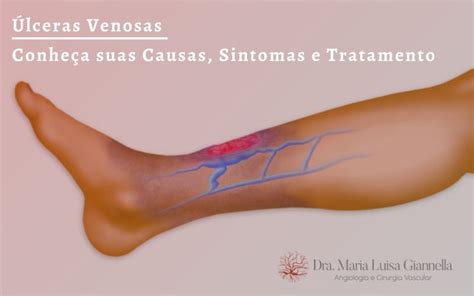 Úlceras Venosas - Conheça suas Causas, Sintomas e Tratamento