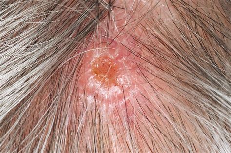 Squamous cell carcinoma of the scalp - Stock Image - C003/3029 ...