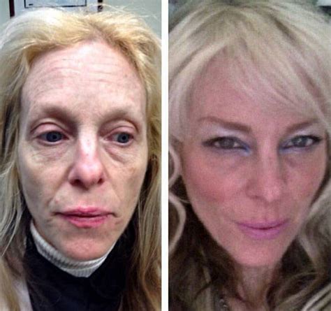 Vampire Facelift Before And After Photos (3) » Facelift: Info, Prices, Photos, Reviews, Q&A