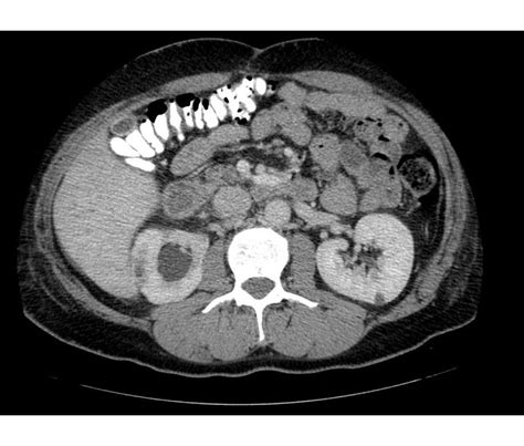 Pyelonephritis CT scan - wikidoc