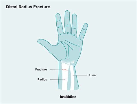 Distal Radius Fracture: Diagnosis, Treatment, and Home Care