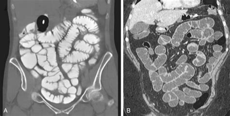 Computed Tomography Enteroclysis | Radiology Key