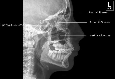 Sinuses Radiographic Anatomy | Radiology student, Medical radiography, Diagnostic imaging