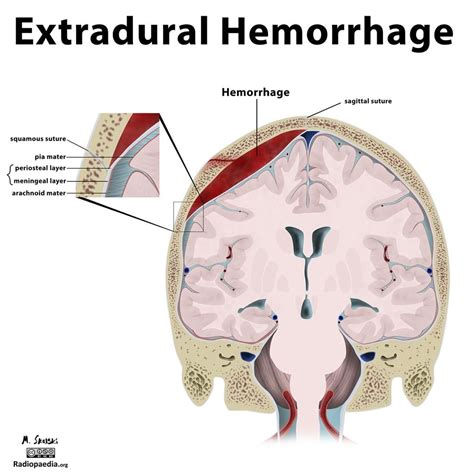 Diagram - intracranial hemorrhage | Radiology Case | Radiopaedia.org | Intracranial hemorrhage ...