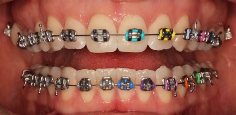 Metal Braces - Peninsula Orthodontics