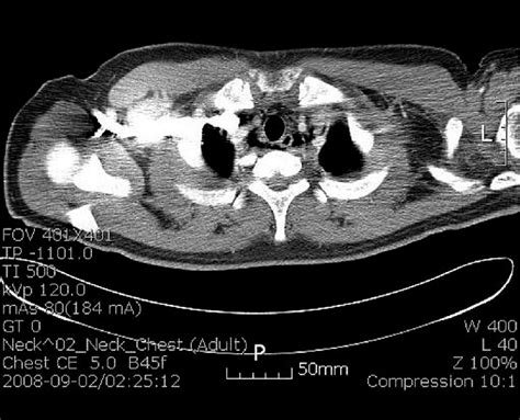 Chest CT scan of case 1 reveals pneumomediastinum | Download Scientific Diagram