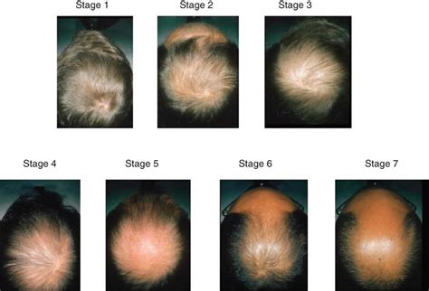 Male or female pattern baldness causes and baldness treament