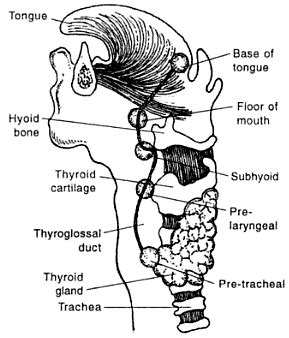 Thyroglossal Duct Cyst | Epomedicine