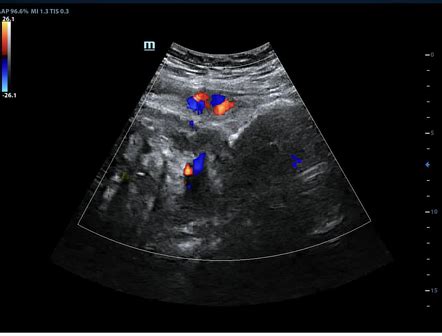 Nuchal cord | Radiology Case | Radiopaedia.org