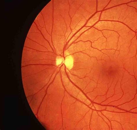 normal retina 2 jpeg - Bloomberg Eye Center