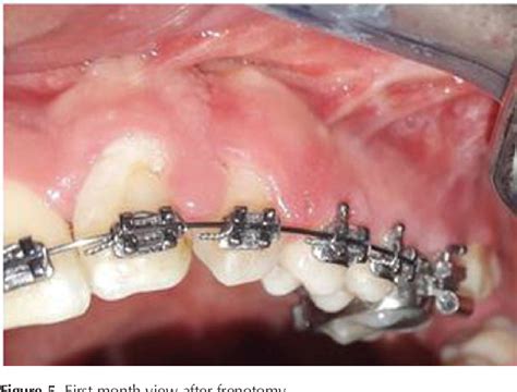 Figure 5 from Frenotomy procedure of a cleft lip and palate case ...