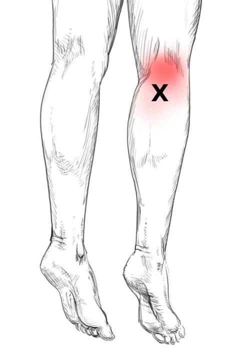 Popliteus – Pain & Trigger Points