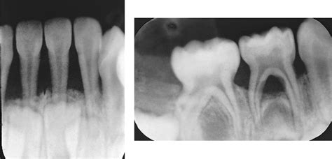 14: Periodontal Conditions | Pocket Dentistry