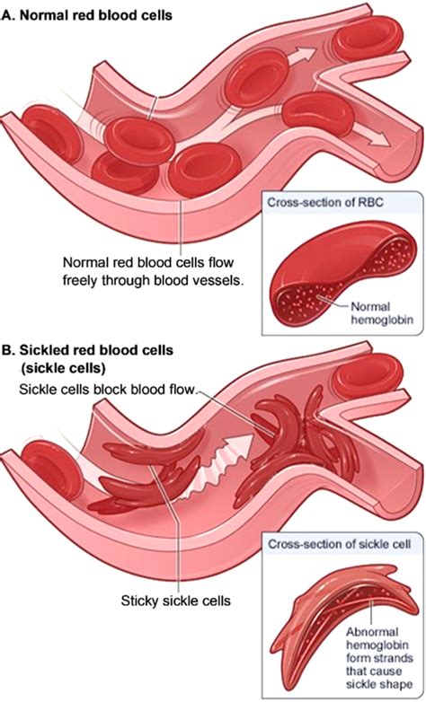 The Genetics of Sickle Cell Anemia and Sickle Cell Trait – How One Gene Affects Multiple ...