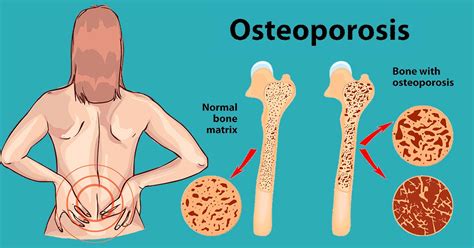 13 Best Ways to Stop Bone Loss Before It’s Too Late! | DailyHealthPost