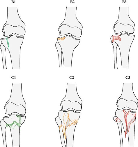 Tibial Plateau Fracture Ao Classification | Porn Sex Picture