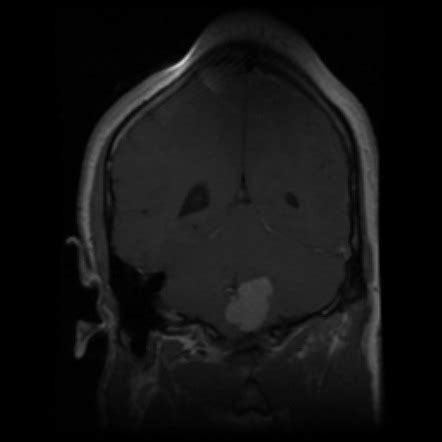 Choroid plexus papilloma | Image | Radiopaedia.org