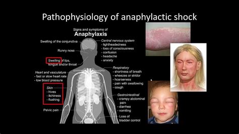 Pathophysiology of anaphylactic shock - YouTube