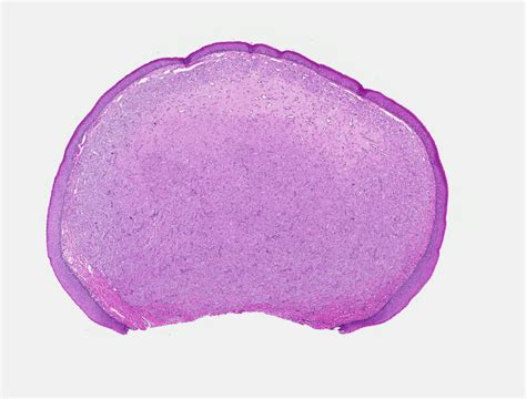 Congenital Epulis Histology