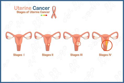 Flat medical vector illustration concept of 4 stages of uterine cancer ...