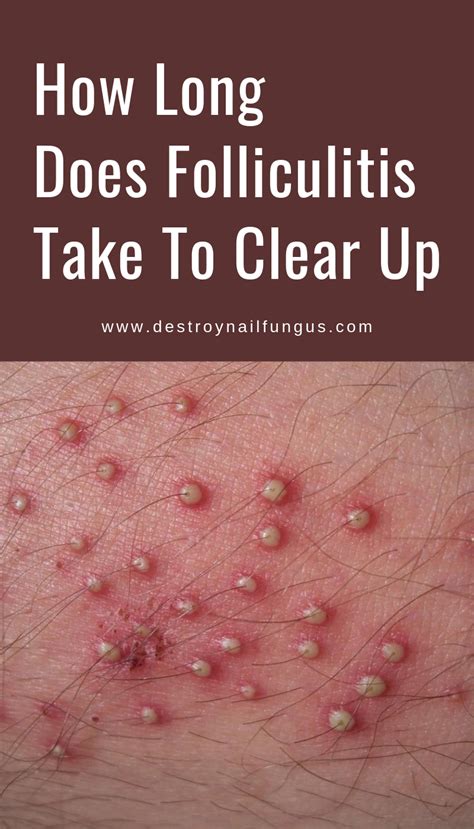 How To Treat Folliculitis On Face – ho.modulartz.com