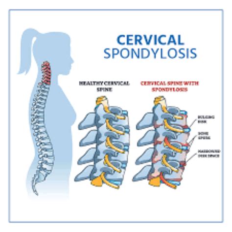 Cervical Spondylosis Treatment in homeopathy, Small Box | ID: 25881761388