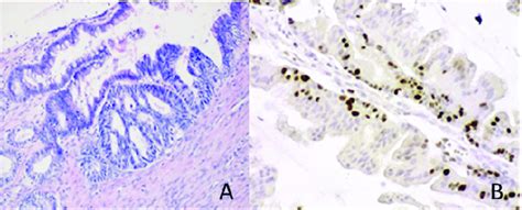 A-B) Borderline mucinous ovarian tumor (case 16) (Hematoxylin and eosin... | Download Scientific ...