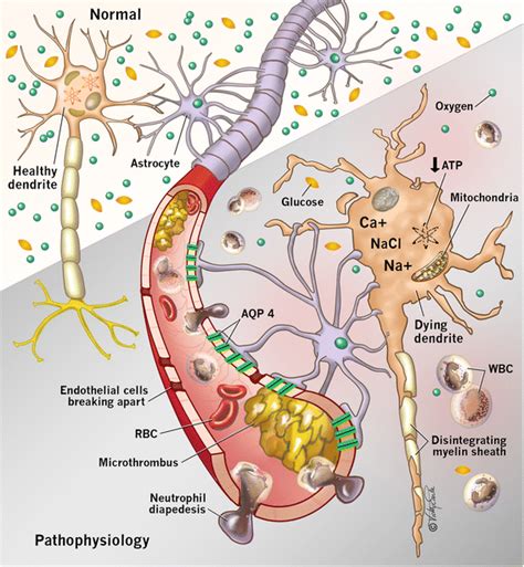 Cerebral hypoxia pathophysiology - wikidoc