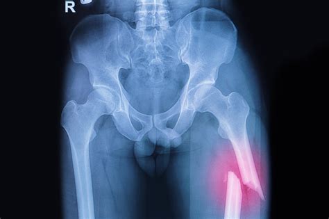 Fracture du fémur : le temps de consolidation