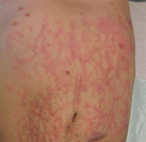 Erythema ab igne causes, symptoms, diagnosis, treatment & prognosis