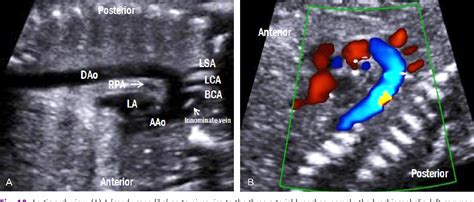 Figure 10 from Technique of fetal echocardiography | Semantic Scholar