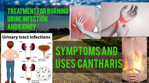 Treatment for burning, Urine infection, and kidney? Symptoms and uses | Cantharis - YouTube