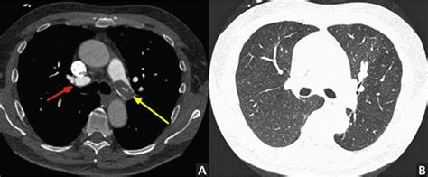 Lung Ct Scan Without Contrast