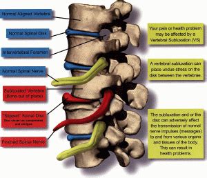 What is a Subluxation? – Tri State Clinic North Chiropractic of Chattanooga