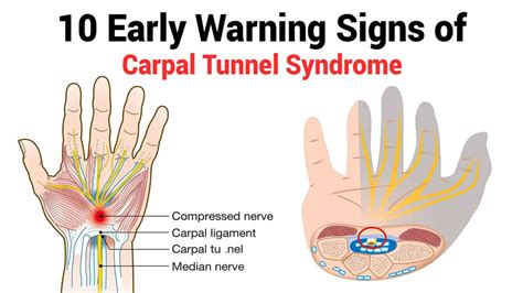 10-Early-Warning-Signs-of-Carpal-Tunnel-Syndrome ⋆ Santa Barbara Deep Tissue - Riktr PRO Massage ...