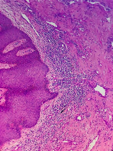 Pathology Outlines - Lymphangioma / lymphatic malformation