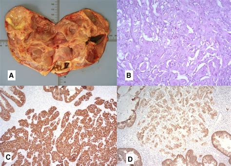 Early-stage mucinous carcinoma (infiltrative type) of the ovary and ...