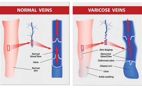 A Hawaii Vein Specialist Explains Why Swollen Legs and Ankles Can Hold You Back In Life ...