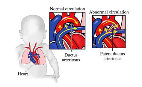 Patent Ductus Arteriosus : Pediatric Heart Defect - HubPages