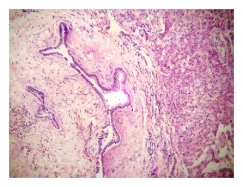 10× histology picture showing dilated bile duct with low columnar... | Download Scientific Diagram