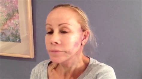 Laura's Facelift Journey Part 3, Post- Op | Dr. Robert Glasgold - YouTube