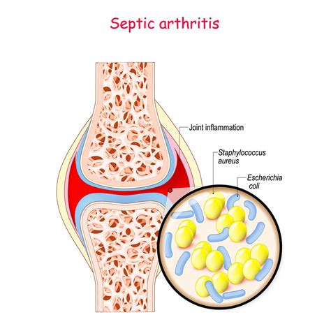 6 Risk Factors of Septic Arthritis You Must Know | Vejthani