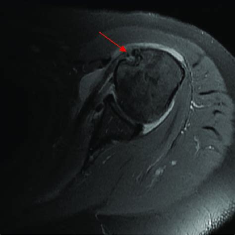 Clinical photograph of a Popeye deformity (blue arrow). (Courtesy of ...