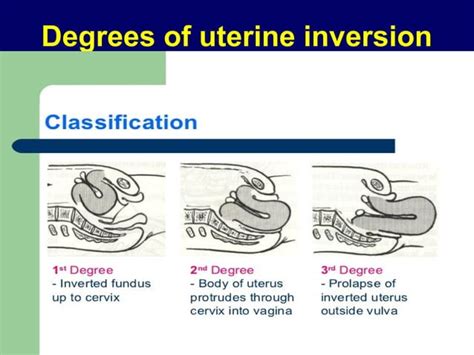 Retroverted retroflexed uterus &uterine inversion